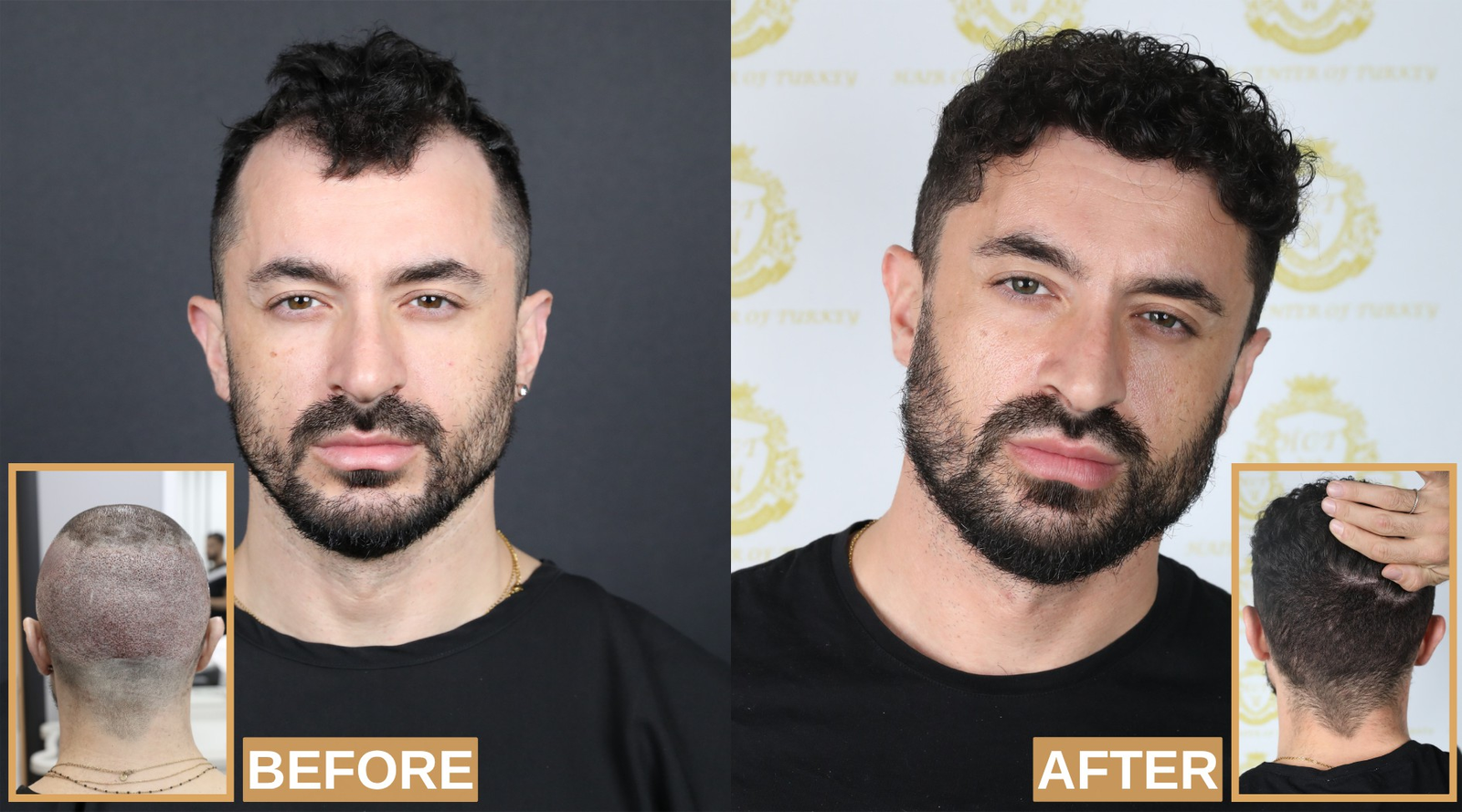 Best Top 10 Hair Transplant Clinics in Turkey
